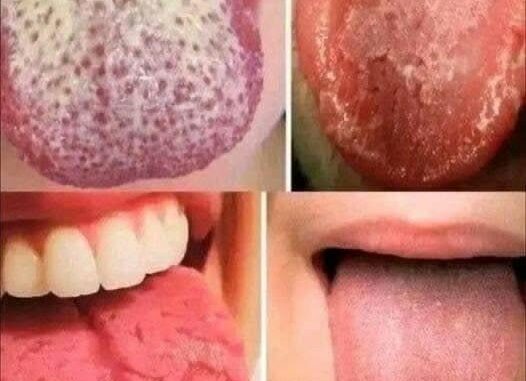 If you have this on your tongue it's because you're... See more