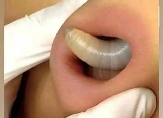 Larvae found in a young woman…See more