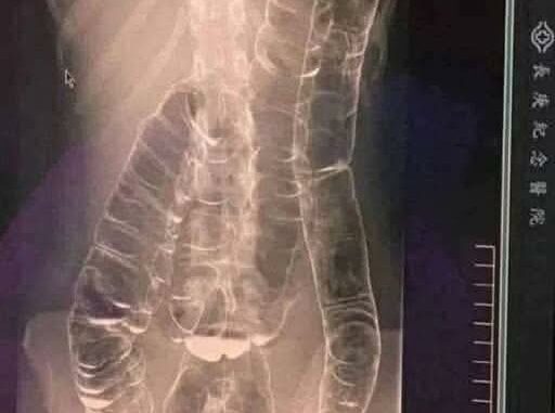 This is an X-ray image of a young woman who suffered from chronic constipation.